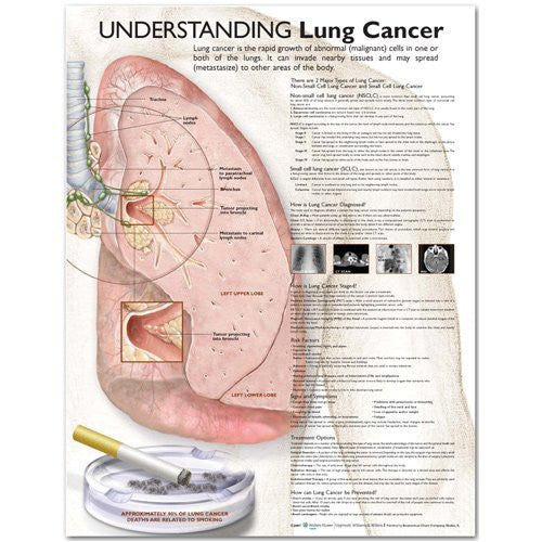 UNDERSTANDING LUNG CANCER LAMINATED WALL CHART - Charles Darwin University Bookshop
