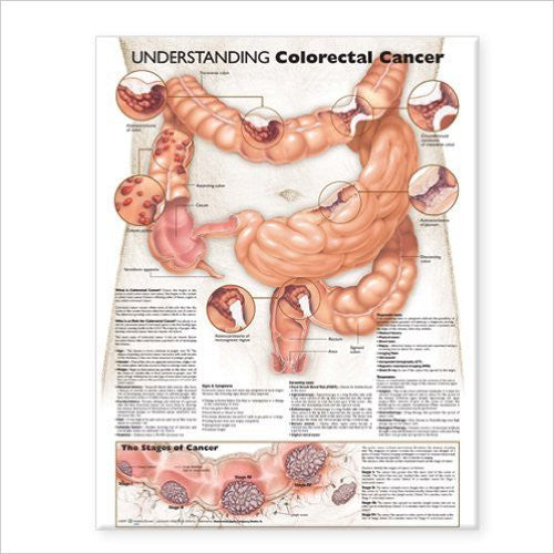 UNDERSTANDING COLORECTAL CANCER LAMINATED WALL CHART - Charles Darwin University Bookshop
